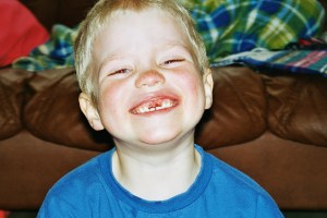 Lucas 4 år har tappat sina framtänder 2